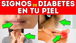 10 SEÑALES ALARMANTES de DIABETES en la PIEL [upl. by Norre748]