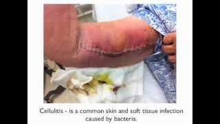 Cellulitis  a patient education video [upl. by Jasen475]