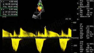 Stenosi polmonare canePulmonic stenosisCardiologia Veterinariaeuwmv [upl. by Ardnasac]