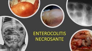 Enterocolitis necrosante [upl. by Geanine]