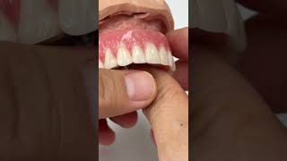 Removable denture [upl. by Nylatsyrk314]