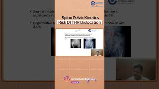 Spino Pelvic Kinetics Risk Of THR Dislocation  Dr Vishal Huggi  Orthopedics Residency [upl. by Bozovich]