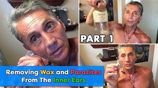 Removing Wax and Parasites From The Inner Ears Part 1  Dr Robert Cassar [upl. by Inan]