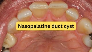 What is nasopalatine duct cyst EASY [upl. by Ettenor]