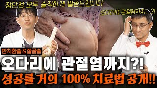 무릎 인공관절 반치환술 오다리와 무릎 관절염까지 치료할 수 있다 [upl. by Trella]