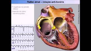 Taquicardia supraventricular  Do diagnóstico ao tratamento [upl. by Maeve]