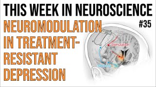 TWiN 35 Neuromodulation in treatmentresistant depression [upl. by Anilah755]