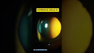 VITREOUS CELLS Vitritis [upl. by Amar]