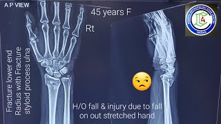 Ligamentotaxis method  Fracture Lower end Radius  Closed reduction under Short GA  Adamya Hosp Vd [upl. by Auhsaj]