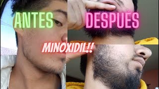 De Lampiño a Barbón utilizando Minoxidil1 año de tratamiento estos fueron mis increibles resultados [upl. by Eniowtna]