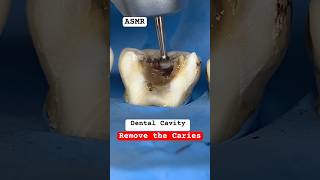 Remove the Caries cavity teethsmiledrmassidental [upl. by Baruch]