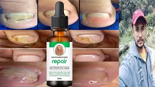 onychomycosis repair  nails repair serum growth nails  honest review [upl. by Esenahs335]