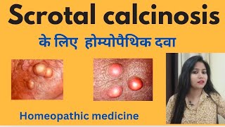 Scrotal calcinosis treatment  Scrotal calcinosis symptomscauses amp homeopathic medicine in hindi [upl. by Cristian]