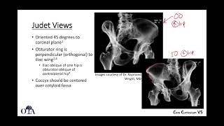 Radiographic evaluation of acetabulum fractures 1 normal anatomy  OTA CCv5 [upl. by Hirsh]