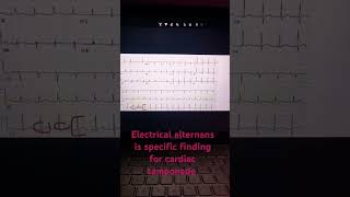 Electrical alternans in ecg [upl. by Juliano]