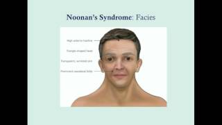 Noonans Syndrome  CRASH Medical Review Series [upl. by Mordecai]