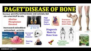 What is Pagets Disease of bone in 3 minutes Symptoms Pathophysiology and Treatment [upl. by Aisatana]