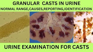 GRANULAR CASTS IN URINECAUSES SYMPTOMS TREATMENT OF GRANULAR CASTS IN URINE EXAMINATION IN HINDI [upl. by Yaresed13]