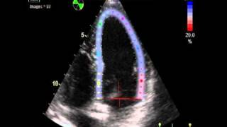 IS EJECTION FRACTION NORMAL 2  STRAIN VALUE  ECHOCARDIOGRAPHY cardiac ultrasound [upl. by Aehtela]