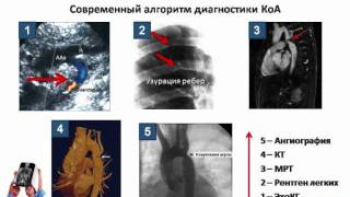 Коарктация аорты симптомы диагностика лечение [upl. by Moyer]