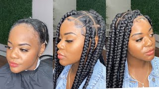 You DONT need a hairline to get box braids Alopecia approved ✅ detailed video [upl. by Ericka545]