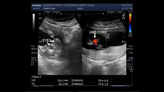 Ultrasound Video showing Anencephaly with a pregnancy of about 19 weeks [upl. by Charlot]