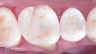 Class IIs restoration with diamond24 and myRing classico clinical case [upl. by Yonatan]