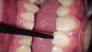 Ankylosis teeth with dull sound [upl. by Gage101]