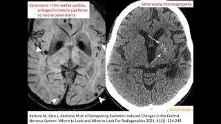 67 Radiation induced cavernoma and mineralising microangiopathy popcorn capillary teleangiectasia [upl. by Tayib]