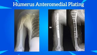 ANTEROMEDIAL PLATING PROXIMAL HUMERUS FRACTURE IN A MIDDLE AGED GENTLEMAN [upl. by Rosenbaum924]