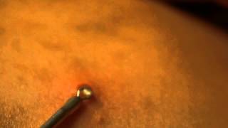 Big White Head Extraction  Awesome Back Zit [upl. by Egduj]