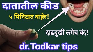 दातातील कीड 5 मिनिटात बाहेर।दाढ दुखीसाठी घरगुती उपाय।dental caries home remedyडॉ तोडकर उपाय दातकिड [upl. by Irmo]