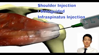 Shoulder Injection Therapy The Ultrasoundguided Approach for Infraspinatus [upl. by Filia]