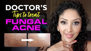 FUNGAL ACNE by DOCTOR V Brown Dark skin of colour SOC  Nizoral bumpy skin clear skin acne [upl. by Notac]