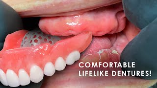 How to Create Comfortable Lifelike Dentures [upl. by Almond]