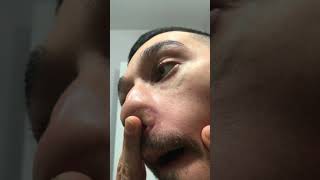 Pimple Popper  Blackhead Extraction Nose Sebaceous Filaments [upl. by Deegan]