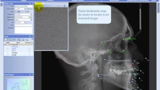 Making analyses in Planmeca Romexis® Cephalometric Analysis module [upl. by Domash]