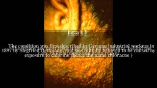 Chloracne Top  5 Facts [upl. by Onitnatsnoc742]