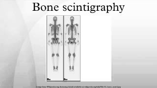 Bone scintigraphy [upl. by Akirderf]