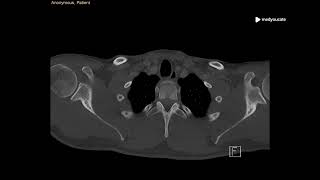 Mediastinal Emphysema  Pneumomediastinum  MedYouCate [upl. by Kneeland]