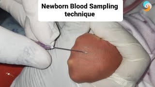 Newborn baby blood sampling technique [upl. by Herzberg257]