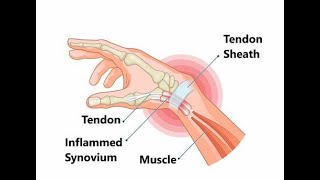 Tenosynovial Crepitus  Definition Meaning Causes Symptoms Treatment [upl. by Catto25]