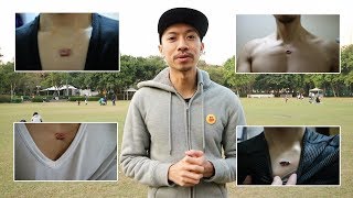 我的蟹足腫治療記事簿：第七集｜再戰疤痕全記錄 My keloid scar treatment ep 7 [upl. by Yelram]