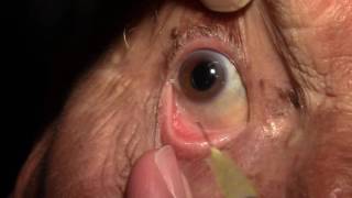 Right Intravitreal Injection of Eylea [upl. by Oigroeg144]