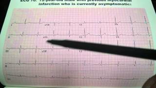 Previous Myocardial Infarction EKG ECG Uri Ben Zur MD [upl. by Bergin]