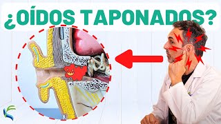 ¿OÍDOS TAPONADOS 🙉 Remedio natural para eliminar el tapón👂 [upl. by Yrrad]