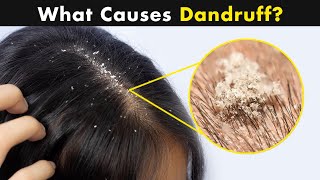 What is Dandruff  Causes And Treatment UrduHindi [upl. by Margie427]