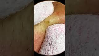 Removing Acne acnes skincare skintreatment [upl. by Amato875]