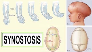 synostosis [upl. by Imogene]