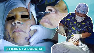 Lipo de papada lipo facial y Reduccion de alas nasales  Dr Cesar Calderon Cirujano Plastico [upl. by Eremihc]